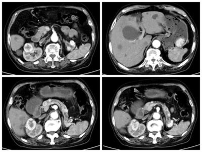 Case report: Endoscopic full-thickness resection of gastric metastatic tumor from renal cell carcinoma